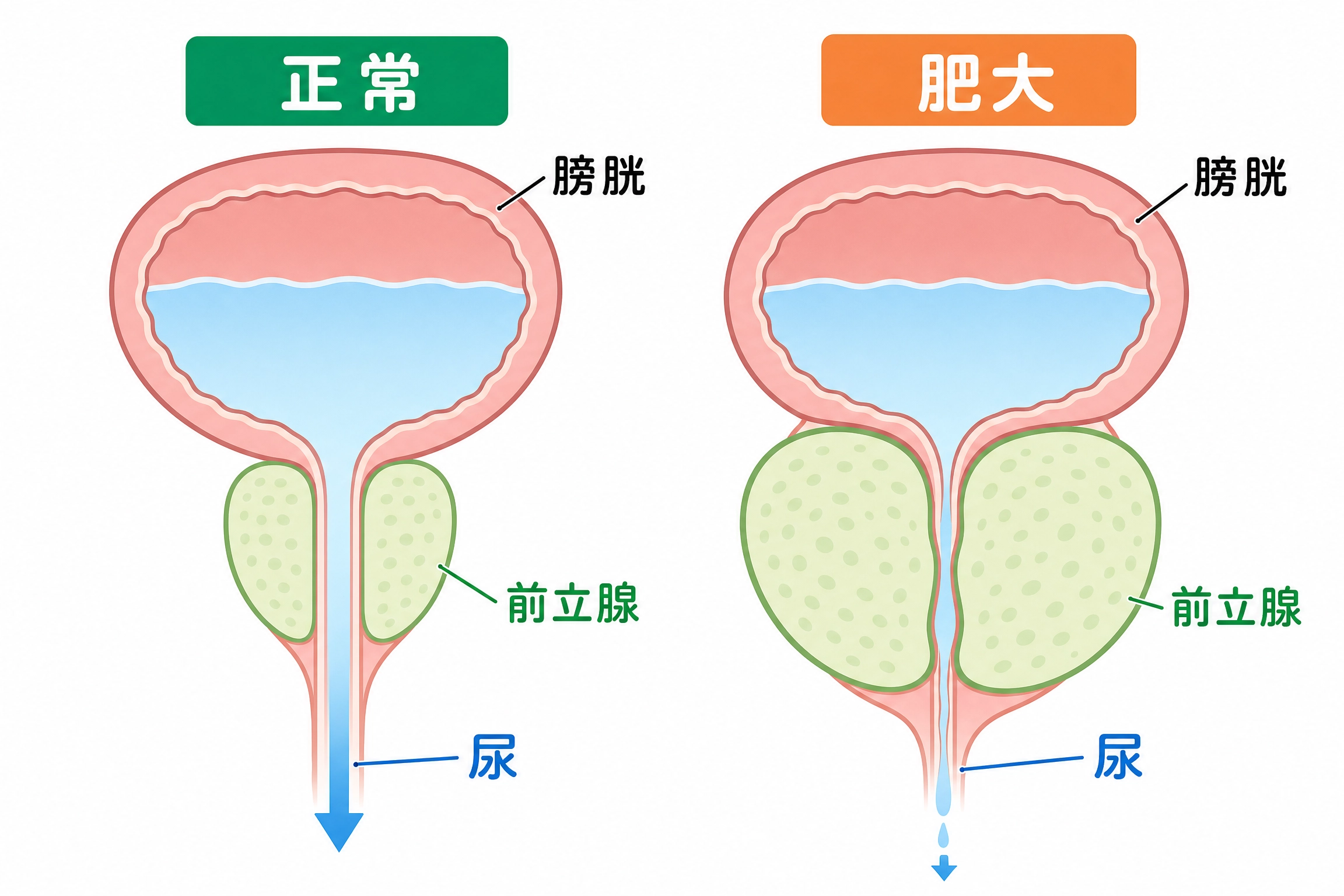 正常な前立腺と肥大した前立腺の比較図